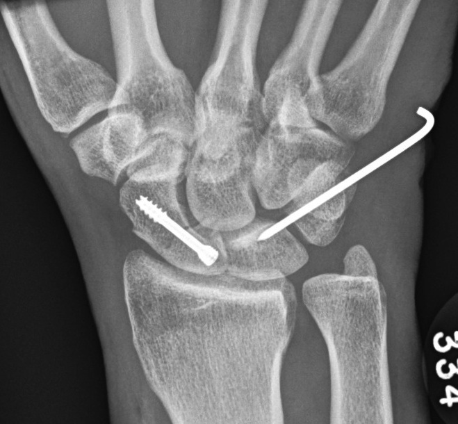 Trans scaphoid Perilunate ORIF